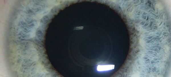 Eye