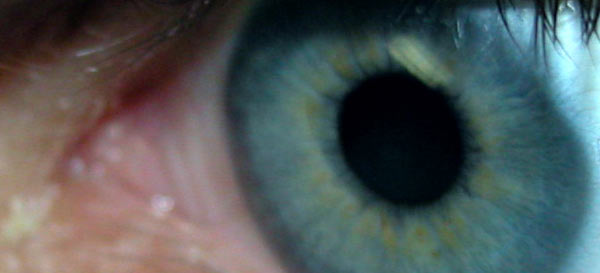 Eye